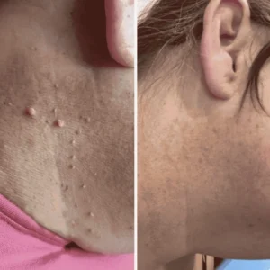 Painless Skin Tag Removal Kit - Image 5