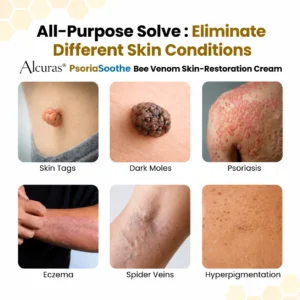 PsoriaSoothe Bee Venom Skin-Restoration Cream - Image 3