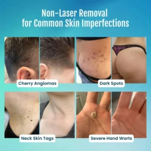 SpotlessPro Advanced Skin Care Pen - Image 3