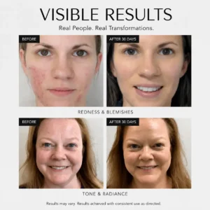 Rosacea Corrector - Image 2