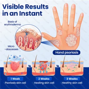 Advanced Psoriasis Relief Spray - Image 5