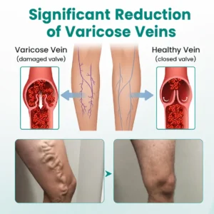LegRenew Varicose Vein Patch - Image 5