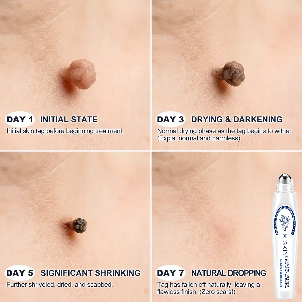 Advanced Wart Removal Pen - Image 4