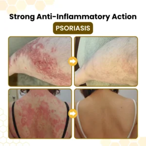 PsoriaSoothe Bee Poison Skin Restoration Cream - Image 3