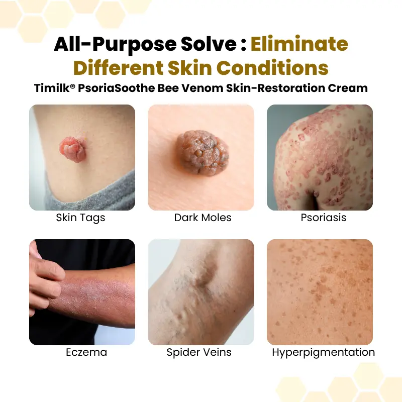 PsoriaSoothe Bee Venom Skin-Restoration Cream - Image 3