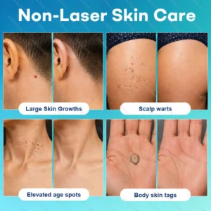 Precision Wart & Blemish Care Roll-On Pen - Image 3