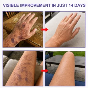All-New Upgraded Dark Spot Correcting - Bruise Healing & Skin Strengthening Cream - Image 2