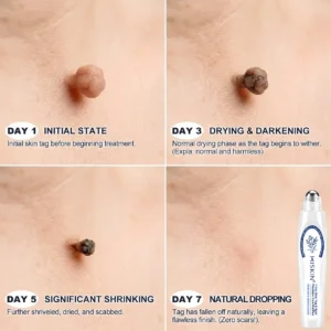 𝟕-𝐃𝒂𝘆 𝐒𝗸𝐢𝐧 𝐓𝒂𝗴 & 𝐒𝐩𝙤𝐭 𝐄𝐫𝒂𝐬𝙚𝐫 Painless & Scar-Free Advanced Imperfection Removal Rollerball Pen - Image 4