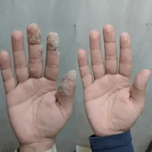 6-in-1 Hydrocolloid Patch - Image 8