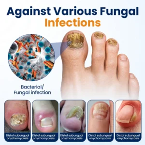 Nail fungus relief spray - Image 7