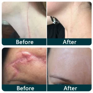 SILICONE SCAR THERAPY ROLL - Image 2