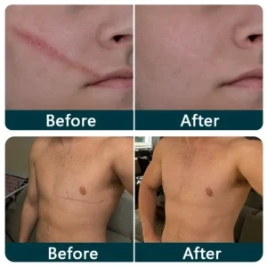SILICONE SCAR THERAPY ROLL - Image 3