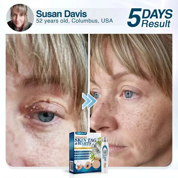 Advanced Skin Tag & Wart Removal Roller - Image 2