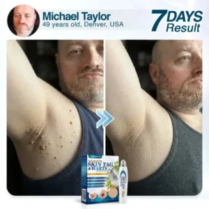 Advanced Skin Tag & Wart Removal Roller - Image 5
