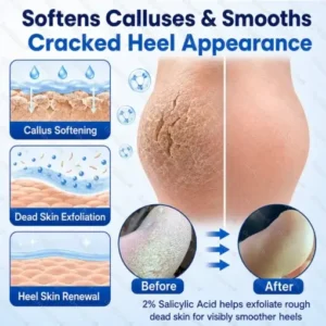 Medical-Grade 2% Salicylic Acid Callus & Cracked Heel Repair Spray - Image 5