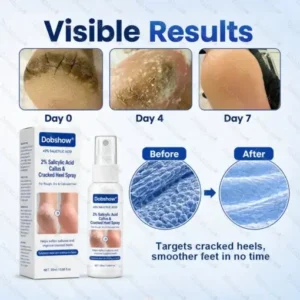 Medical-Grade 2% Salicylic Acid Callus & Cracked Heel Repair Spray - Image 8