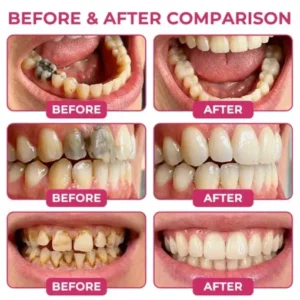 KLENIMORE DenPerm Cavity-Repair Natural Enamel Filling Gel - Image 2