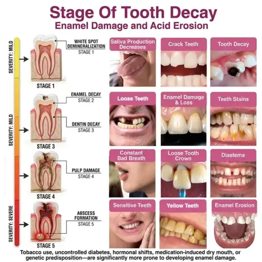 KLENIMORE DenPerm Cavity-Repair Natural Enamel Filling Gel - Image 6