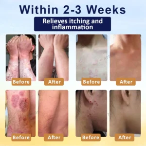 PsoriasisCare Mellifera Venom Skin Healing Spray - Image 3
