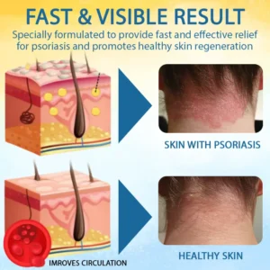 PsoriasisCare Mellifera Venom Skin Healing Spray - Image 5