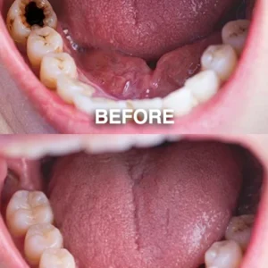DenPerm Cavity-Repair Natural Enamel Filling Gel - Image 5
