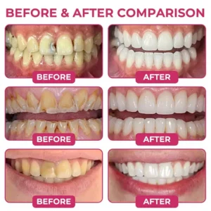 🦷 DenPerm Advanced Enamel Repair Biomimetic Protein Gel - Image 4