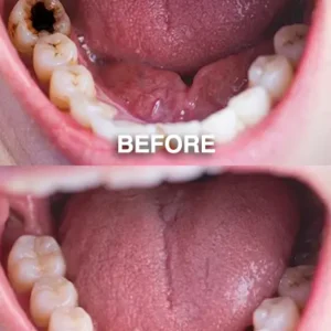 DenPerm – Natural Enamel Repair & Cavity Filling Gel - Image 11